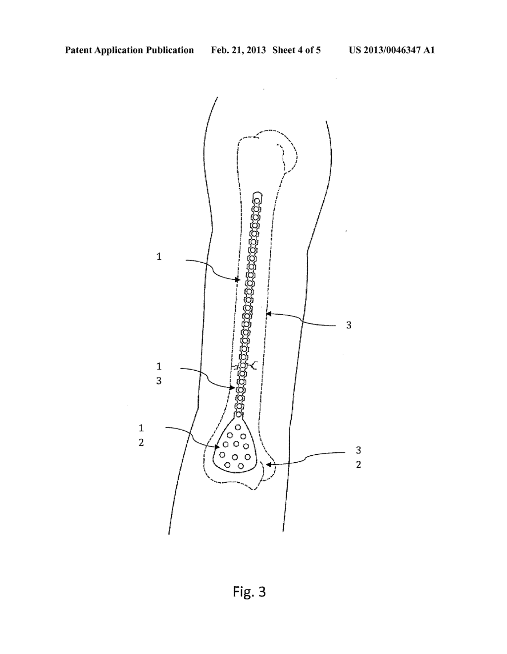 BENDABLE BONE PLATE FOR EXTERNAL FIXATION - diagram, schematic, and image 05