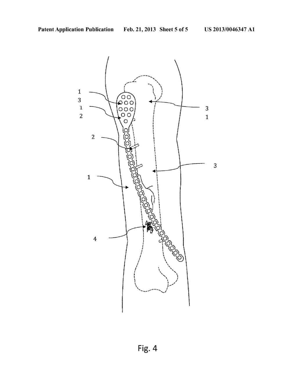 BENDABLE BONE PLATE FOR EXTERNAL FIXATION - diagram, schematic, and image 06