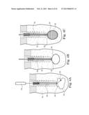 FIXATION SYSTEM FOR ORTHOPEDIC DEVICES diagram and image