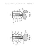 FIXATION SYSTEM FOR ORTHOPEDIC DEVICES diagram and image