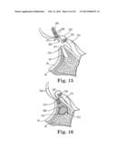 FIXATION SYSTEM FOR ORTHOPEDIC DEVICES diagram and image