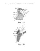 FIXATION SYSTEM FOR ORTHOPEDIC DEVICES diagram and image