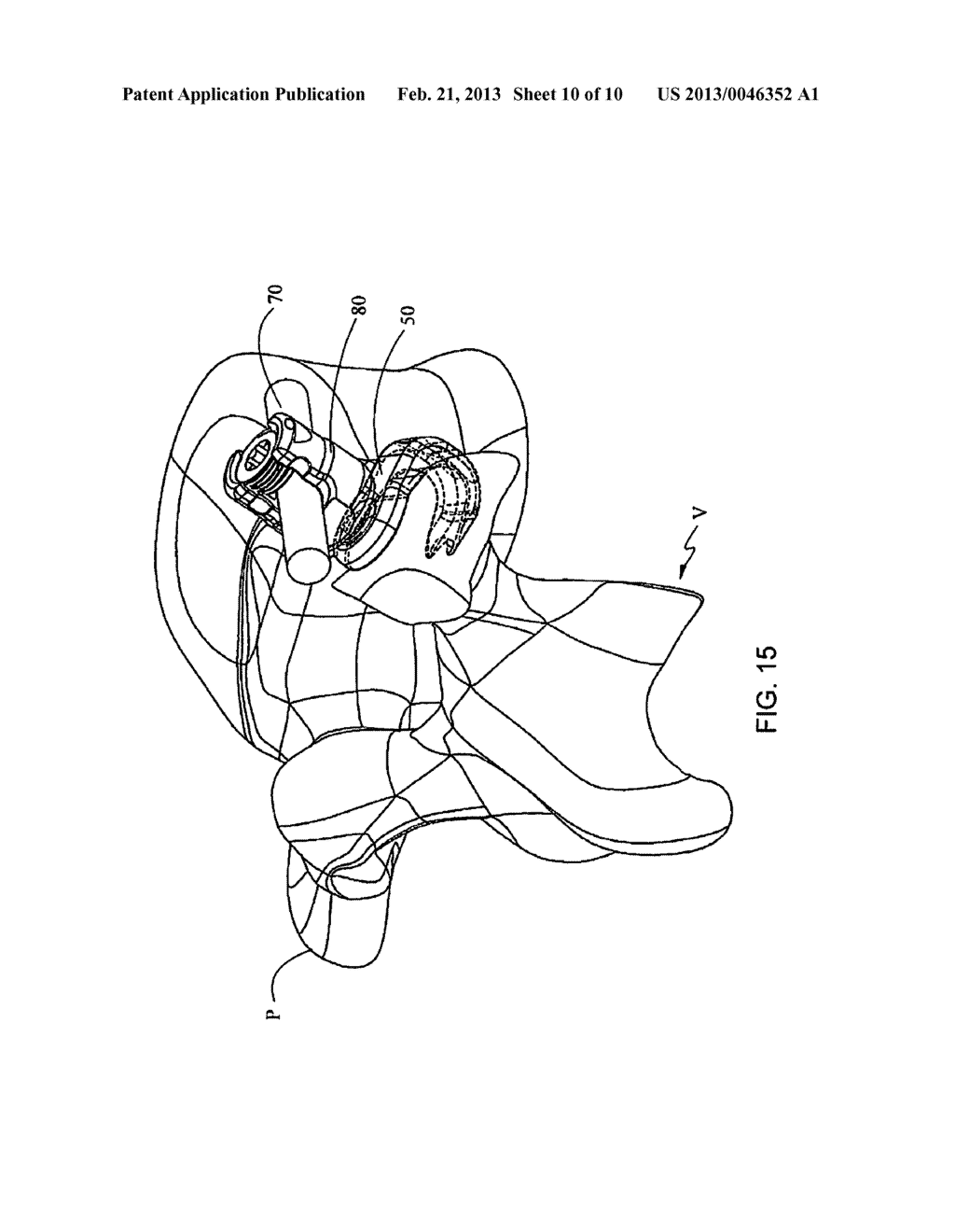 LAMINAR HOOK INSERTION DEVICE - diagram, schematic, and image 11