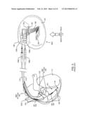 IMPLANTABLE CARDIOVERTER DEFIBRILLATOR DESIGNED FOR USE IN A MAGNETIC     RESONANCE IMAGING ENVIRONMENT diagram and image