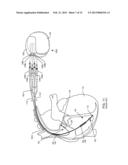 IMPLANTABLE CARDIOVERTER DEFIBRILLATOR DESIGNED FOR USE IN A MAGNETIC     RESONANCE IMAGING ENVIRONMENT diagram and image