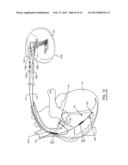 IMPLANTABLE CARDIOVERTER DEFIBRILLATOR DESIGNED FOR USE IN A MAGNETIC     RESONANCE IMAGING ENVIRONMENT diagram and image