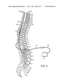 MOLDABLE CHARGER WITH SHAPE-SENSING MEANS FOR AN IMPLANTABLE PULSE     GENERATOR diagram and image