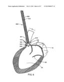 Apparatus for Replacing a Cardiac Valve diagram and image