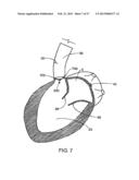 Apparatus for Replacing a Cardiac Valve diagram and image