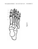 TOE JOINT REPLACEMENT MODELS diagram and image