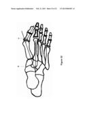 TOE JOINT REPLACEMENT MODELS diagram and image