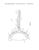 METHODS AND SYSTEMS FOR TREATING MEIBOMIAN GLAND DYSFUNCTION USING     RADIO-FREQUENCY ENERGY diagram and image