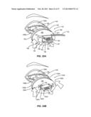 METHODS AND SYSTEMS FOR TREATING MEIBOMIAN GLAND DYSFUNCTION USING     RADIO-FREQUENCY ENERGY diagram and image