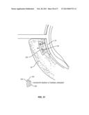 METHODS AND SYSTEMS FOR TREATING MEIBOMIAN GLAND DYSFUNCTION USING     RADIO-FREQUENCY ENERGY diagram and image