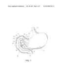 Anti-Obesity Diverter Structure diagram and image