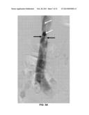 INTERVENTIONAL RADIOLOGIC DEVICES AND METHODS FOR EMBEDDED FILTER REMOVAL diagram and image
