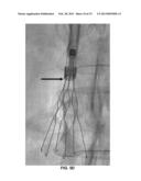 INTERVENTIONAL RADIOLOGIC DEVICES AND METHODS FOR EMBEDDED FILTER REMOVAL diagram and image