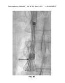 INTERVENTIONAL RADIOLOGIC DEVICES AND METHODS FOR EMBEDDED FILTER REMOVAL diagram and image