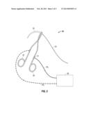 Integrated Suture and Cauterization diagram and image