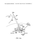 ACCESS AND TISSUE MODIFICATION SYSTEMS AND METHODS diagram and image