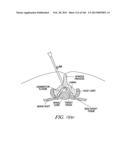 ACCESS AND TISSUE MODIFICATION SYSTEMS AND METHODS diagram and image