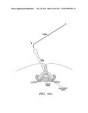 ACCESS AND TISSUE MODIFICATION SYSTEMS AND METHODS diagram and image