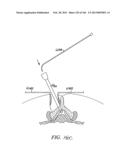 ACCESS AND TISSUE MODIFICATION SYSTEMS AND METHODS diagram and image