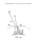 ACCESS AND TISSUE MODIFICATION SYSTEMS AND METHODS diagram and image