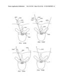 ACCESS AND TISSUE MODIFICATION SYSTEMS AND METHODS diagram and image