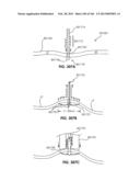 ACCESS AND TISSUE MODIFICATION SYSTEMS AND METHODS diagram and image