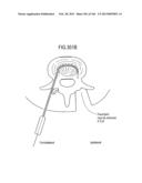 ACCESS AND TISSUE MODIFICATION SYSTEMS AND METHODS diagram and image