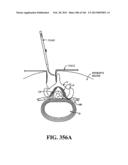 ACCESS AND TISSUE MODIFICATION SYSTEMS AND METHODS diagram and image