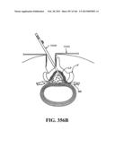 ACCESS AND TISSUE MODIFICATION SYSTEMS AND METHODS diagram and image