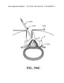 ACCESS AND TISSUE MODIFICATION SYSTEMS AND METHODS diagram and image