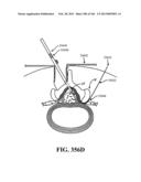 ACCESS AND TISSUE MODIFICATION SYSTEMS AND METHODS diagram and image