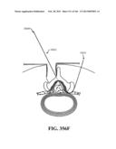 ACCESS AND TISSUE MODIFICATION SYSTEMS AND METHODS diagram and image