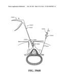 ACCESS AND TISSUE MODIFICATION SYSTEMS AND METHODS diagram and image