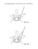 ACCESS AND TISSUE MODIFICATION SYSTEMS AND METHODS diagram and image