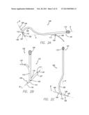 PRECISION HIP REPLACEMENT METHOD diagram and image