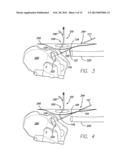 PRECISION HIP REPLACEMENT METHOD diagram and image