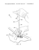 PRECISION HIP REPLACEMENT METHOD diagram and image