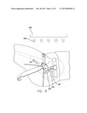 PRECISION HIP REPLACEMENT METHOD diagram and image