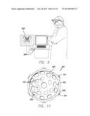 PRECISION HIP REPLACEMENT METHOD diagram and image