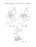 PRECISION HIP REPLACEMENT METHOD diagram and image