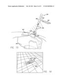 PRECISION HIP REPLACEMENT METHOD diagram and image