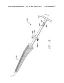 PRECISION HIP REPLACEMENT METHOD diagram and image