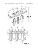 Suture and Retainer Assembly and SULU diagram and image