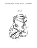 COIL OCCLUSION DEVICES AND SYSTEMS AND METHODS OF USING THE SAME diagram and image