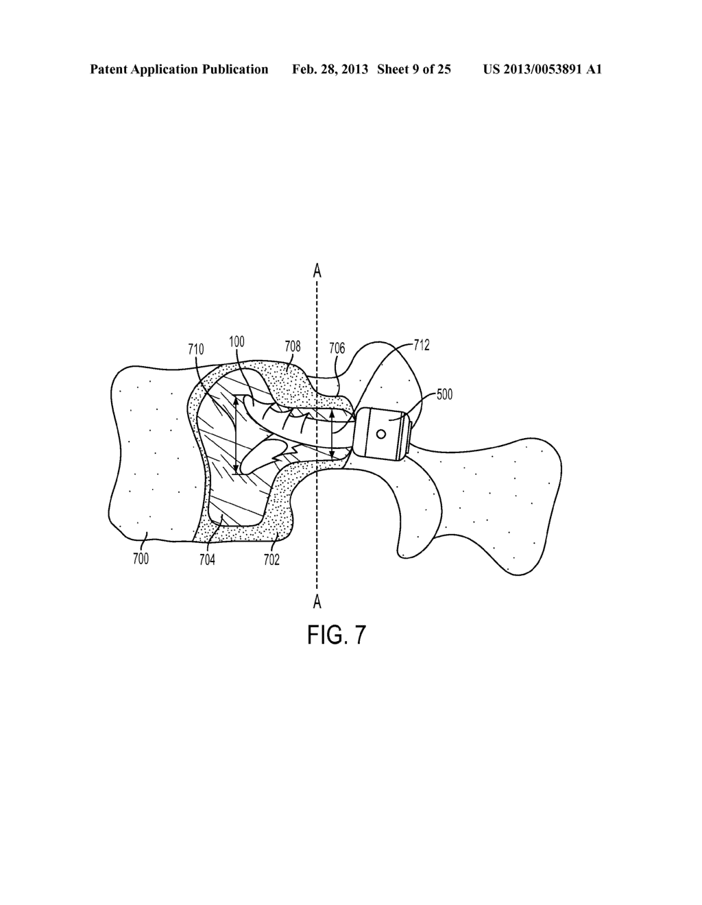 REVISABLE ORTHOPEDIC ANCHOR AND METHODS OF USE - diagram, schematic, and image 10