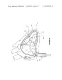 HOLDING MEMBERS FOR IMPLANTABLE CARDIAC STIMULATION DEVICES diagram and image